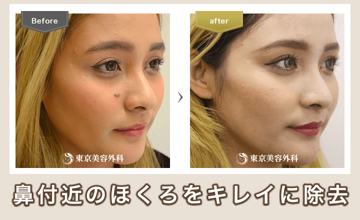 東京美容外科、ほくろ除去の症例写真1