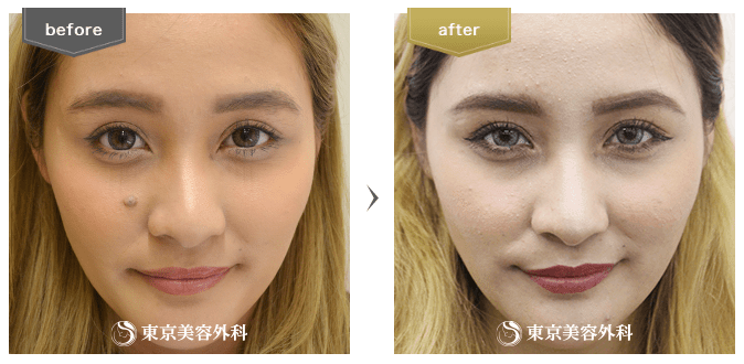 東京美容外科、ほくろ除去の症例写真3